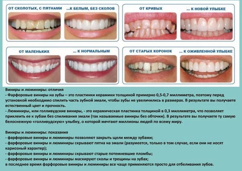 Можно ли есть зубы. Виниры для выравнивания зубов. Схема установки виниров. Долго выравниваются зубы.