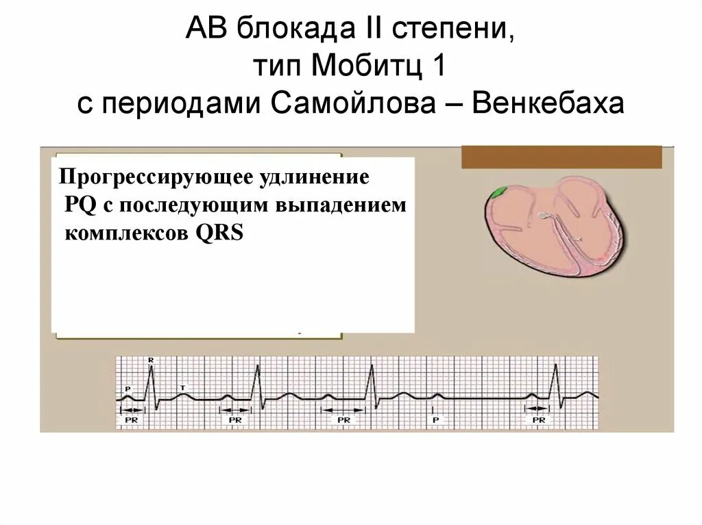 Атриовентрикулярная блокада 2. Атриовентрикулярная блокада типа Мобитц 2. Av блокада 2 степени Тип 2 Мобитц 2. Периоды Самойлова-Венкебаха на ЭКГ. АВ блокада 2 типа Мобитц 1.