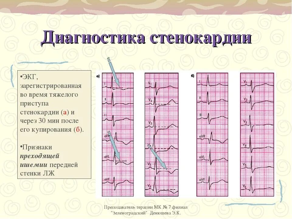 Экг при стенокардии напряжения 1 фк. Экг покажет стенокардию. Экг покажет стенокардию. Экг покажет стенокардию. Экг покажет стенокардию.