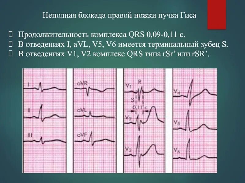 Блокада ножки гиса причины. AVL блокада пучка Гиса. Блокада правой ножки пучка Гиса на Холтере. QRS v5 v6. QRS блокада правой ножки пучка Гиса.