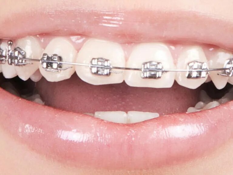 Сапфировые брекеты radiance. Установка брекетов пермь. Установка брекетов пермь. Самолигирующие брекеты. Установка брекетов пермь.