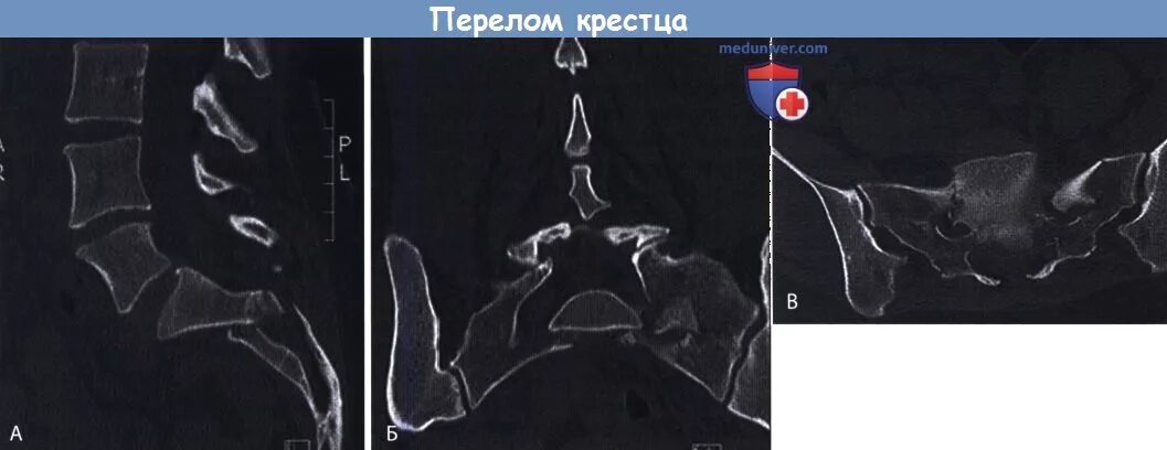 Трещина крестца