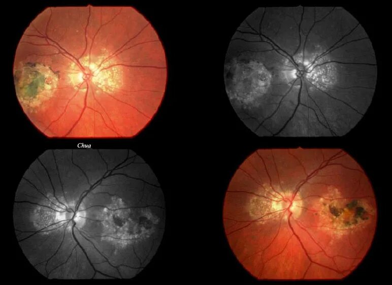 Периферические ретинальные дегенерации. Периферическая хориоретинальная дистрофия сетчатки. Центральная хориоретинальная дистрофия сетчатки.