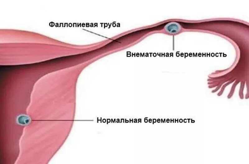 Внематочная беременность тест. Зачатие с одной трубой. Внематочная беременнос. Внематочная беременность. Формы внематочной беременности.