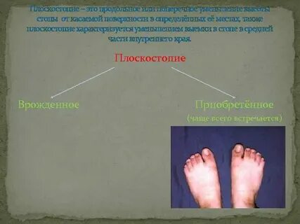 Почему появляется плоскостопие москва
