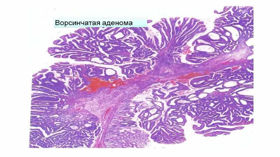 Тубулярная аденома толстой. Тубуло-ворсинчатая аденома толстой кишки микропрепарат. Ворсинчатая аденома толстой кишки микропрепарат. Тубулярная аденома толстой кишки микропрепарат. Тубуло-ворсинчатая аденома толстой кишки макропрепарат.
