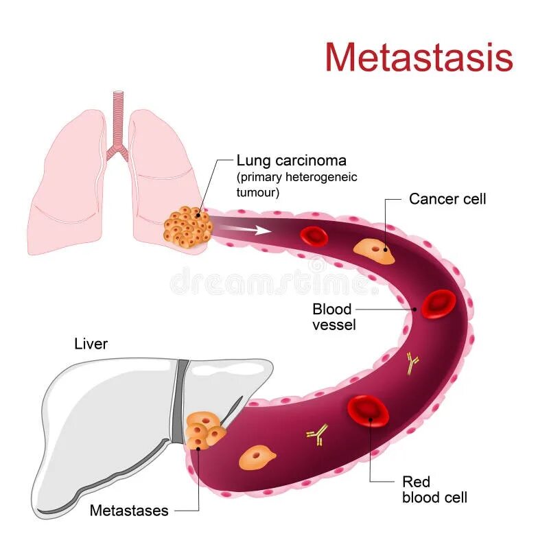 Metastasis. Metastases stock vector. Illustration of liver - 72369455