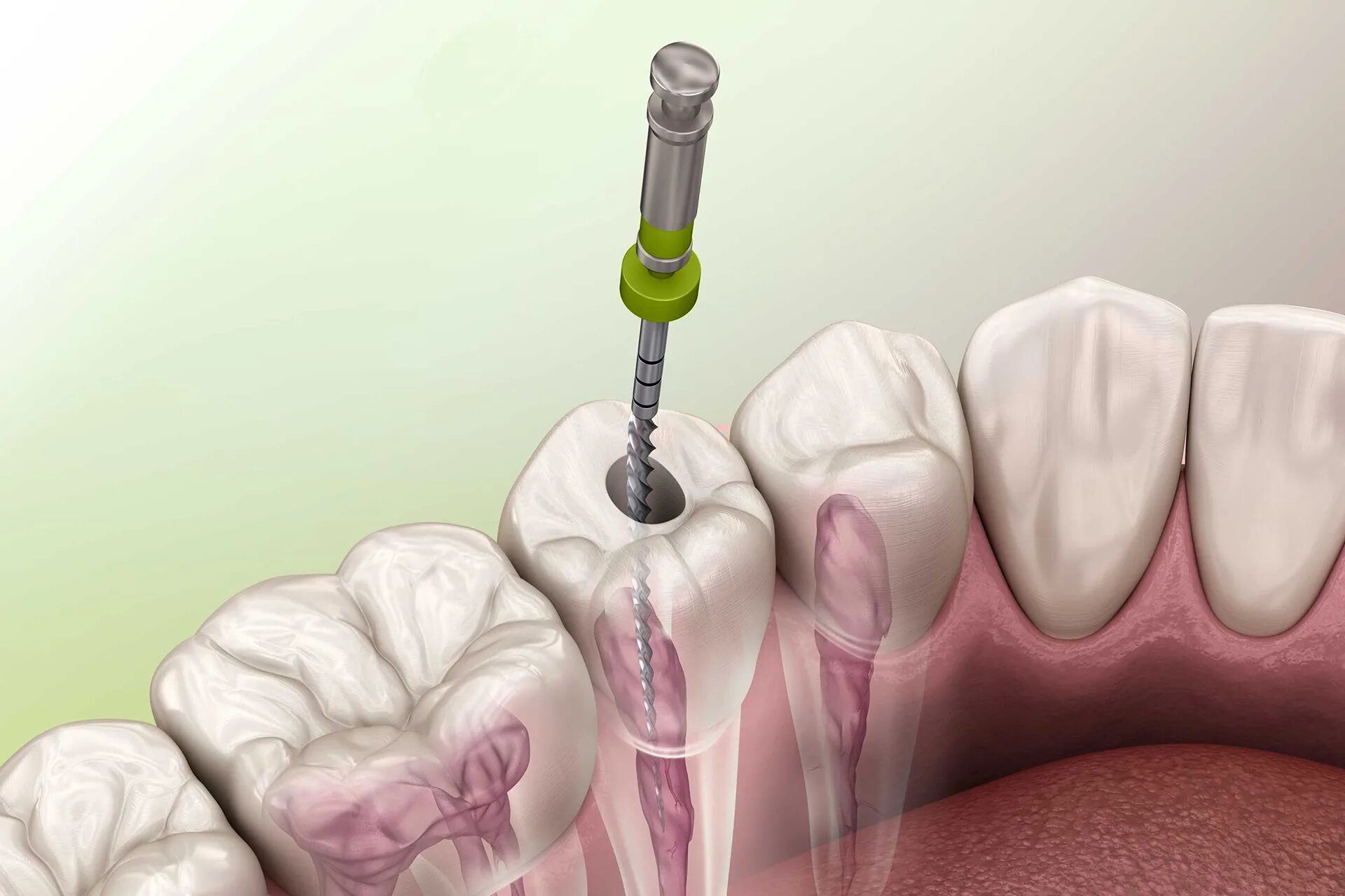 Эндодонтическое перелечивание зубов. Пульпит корневого канала.
