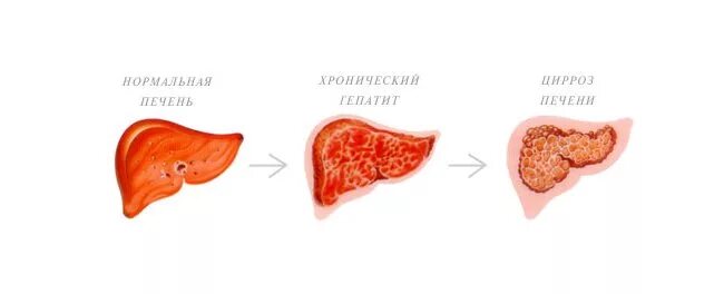 Липидоз печени. Цирроз печени у животных. гепатит печени у животных. печень собаки при гепатите.
