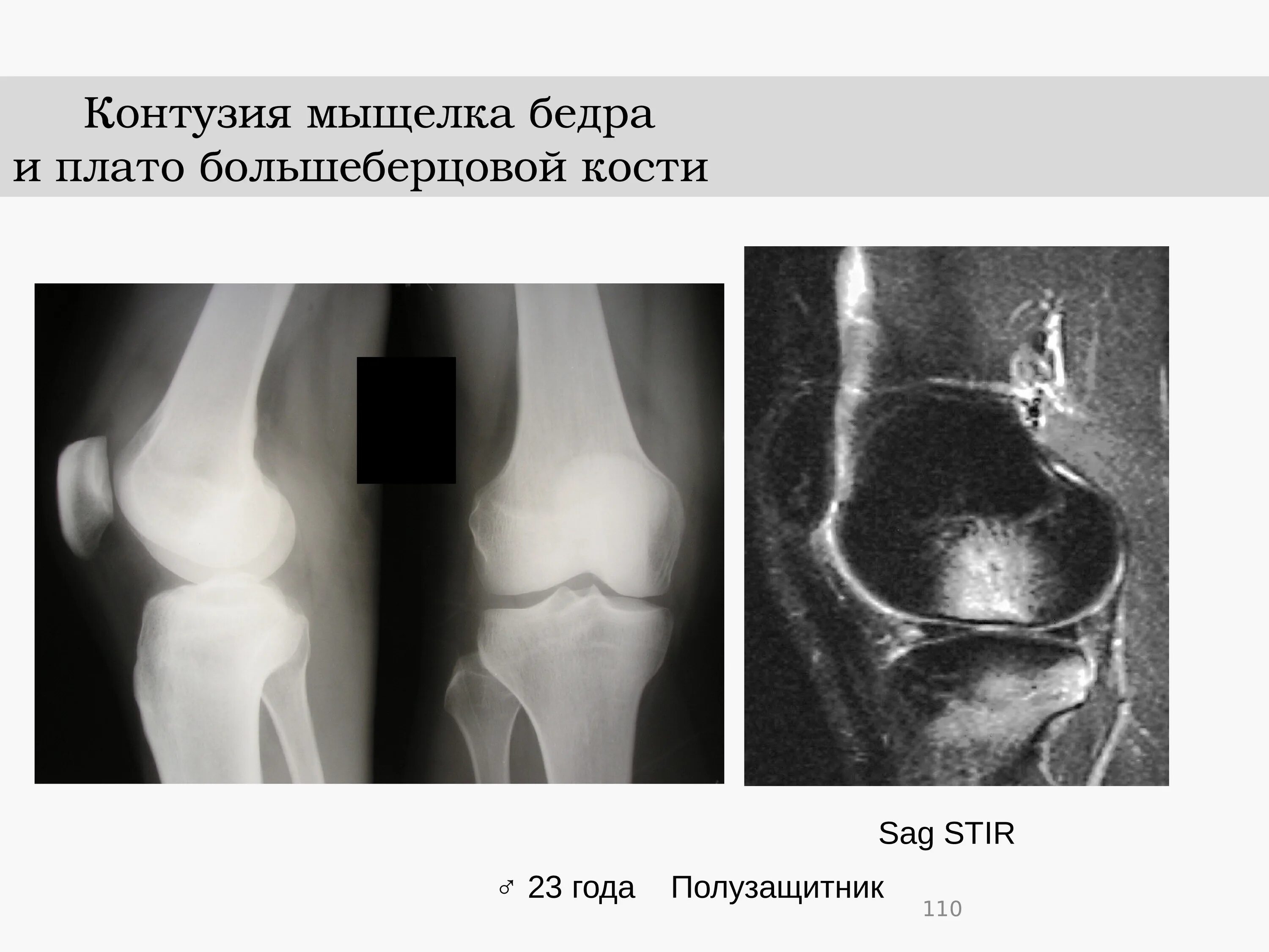 Внутренний мыщелок большеберцовой. Перелом наружного мыщелка большеберцовой кости рентген. Переломы мыщелков бедренной кости. Перелом мыщелков большеберцовой кости рентген. Перелом плато большеберцовой кости рентген.