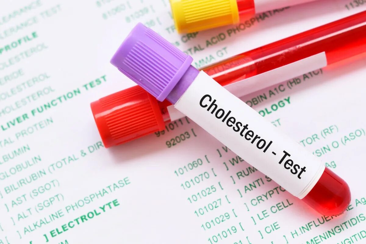 Холестерин в пробирке. Кровь в пробирке с холестерином. Cholesterol Test. Пробирка холестерин рисунок.