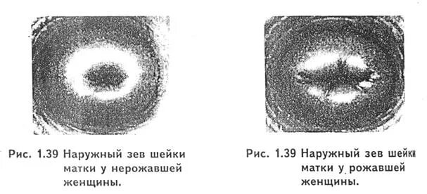 Маточный зев. Рубцовая деформация наружного зева шейки матки. Форма зева шейки матки. Коническая и цилиндрическая шейка матки.