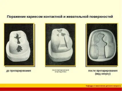 Наличие кариозных полостей