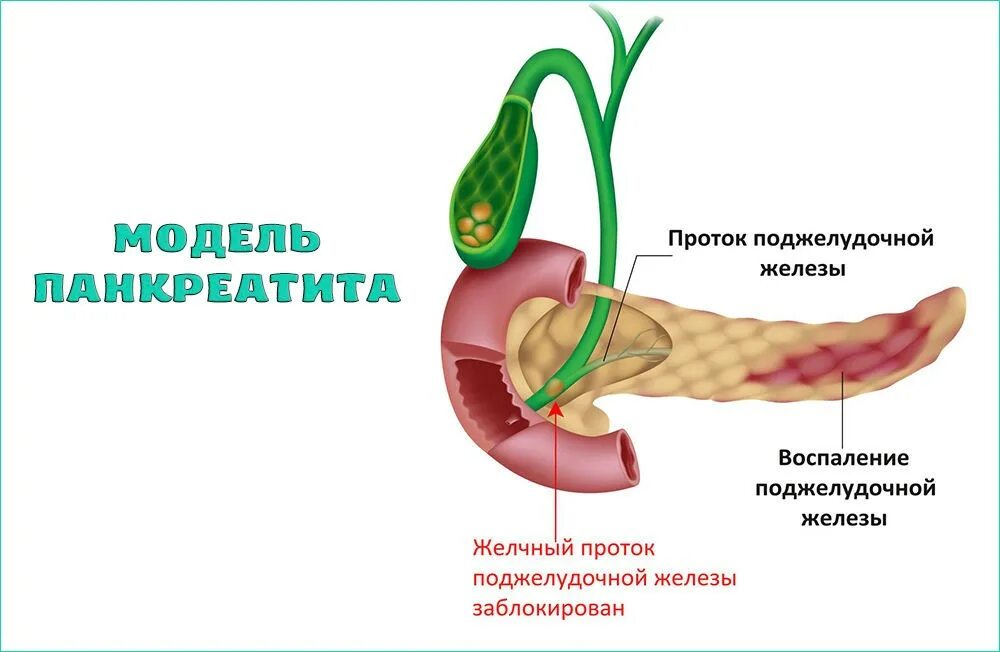 Можно вылечить панкреатит поджелудочной. Стент для кист поджелудочной железы. как помочь поджелудочной железе восстановиться. кислотность поджелудочной железы.