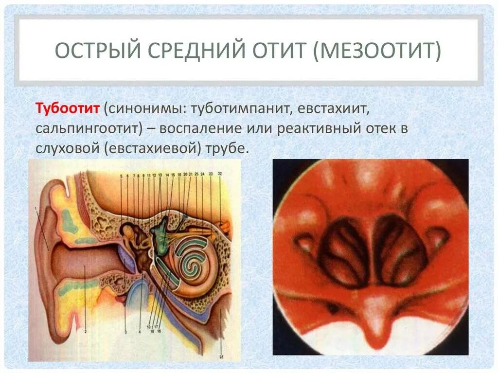 Хронический тубоотит