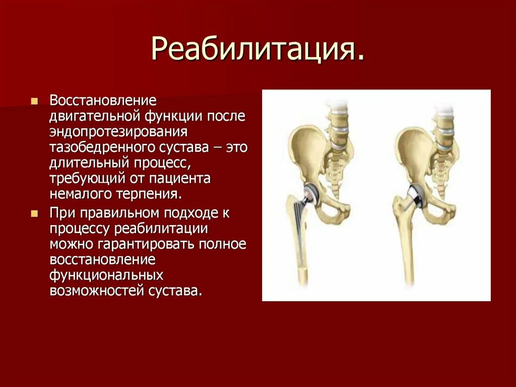 Реабилитационный центр замена тазобедренного сустава. После эндопротезирования тазобедренного сустава. упражнения для эндопротезирования тазобедренного сустава. брошюра для пациентов с эндопротезированием тазобедренного сустава. рекомендации эндопротезирование тазобедренного суставв.