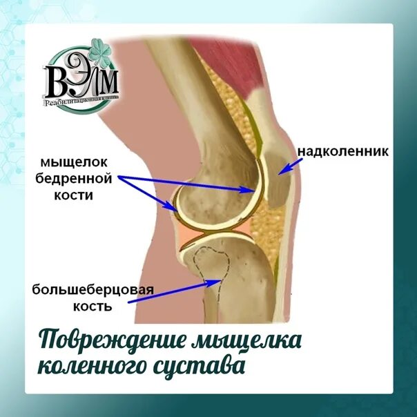 Отек медиального мыщелка