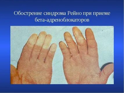 Синдром рейна