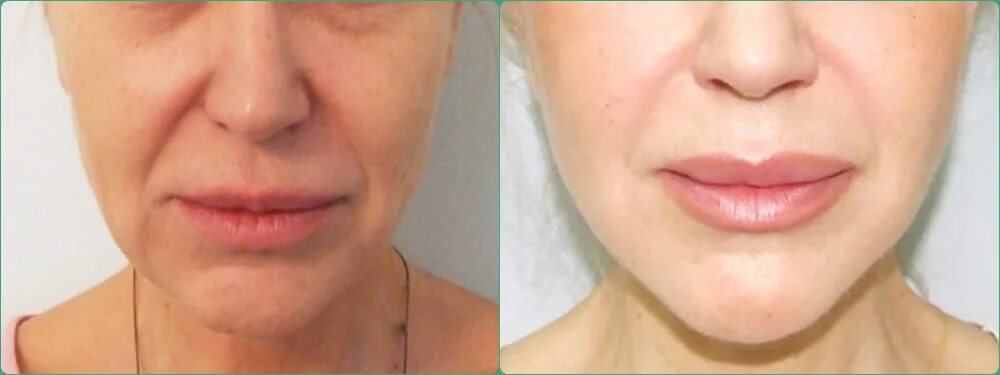 Увеличение губ juvederm ultra 3. Липофилинг верхней губы. Увеличение губ липофилинг. Накаченные губы липофилинг. Липофилинг губ до и после.