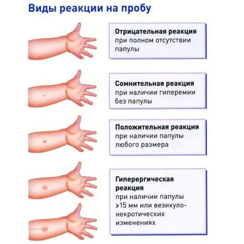 Манту размеры норма у детей 7. Туберкулиновая проба реакция манту. Прививка манту в 1 год реакция норма у детей. Какая должна быть реакция на манту у ребенка в 7 лет норма. Диаскинтест Размеры норма у детей.