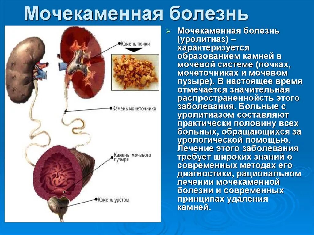 День заболевания почек. Заболевания мочевыделительной системы мочекаменная болезнь. Мочекаменная болезнь патанатомия. Почечнокаменная болезнь механизмы образования почечных камней. При мочекаменной болезни конкременты образуются в.