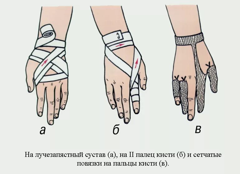 Повязка на руку схема. Перевязка при переломе кисти. Восьмиобразная повязка на кисть показания. Наложение повязки на палец. Наложение повязки на кисть.