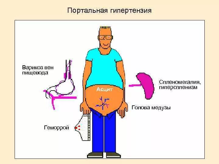 Гипертонии печень. Портальная гипертензия спленомегалия. Портальная гипертензия асцит. Симптомы портальной гипертензии голова медузы. Портальная гипертензия симптомы.