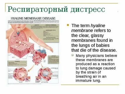 Респираторный дистресс новорожденных