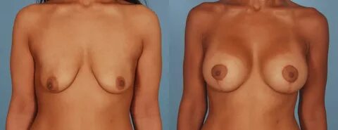 Breast Augmentation vs. Breast Lift. 