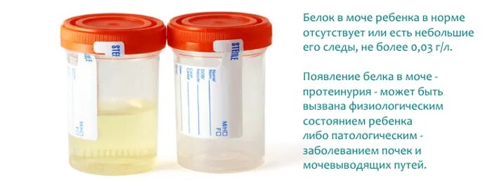 Белок в моче в 38 недель. Белок в моче у ребенка показатели. белок в моче физиологические причины. белок в моче протеинурия. препараты повышающие белок в моче.