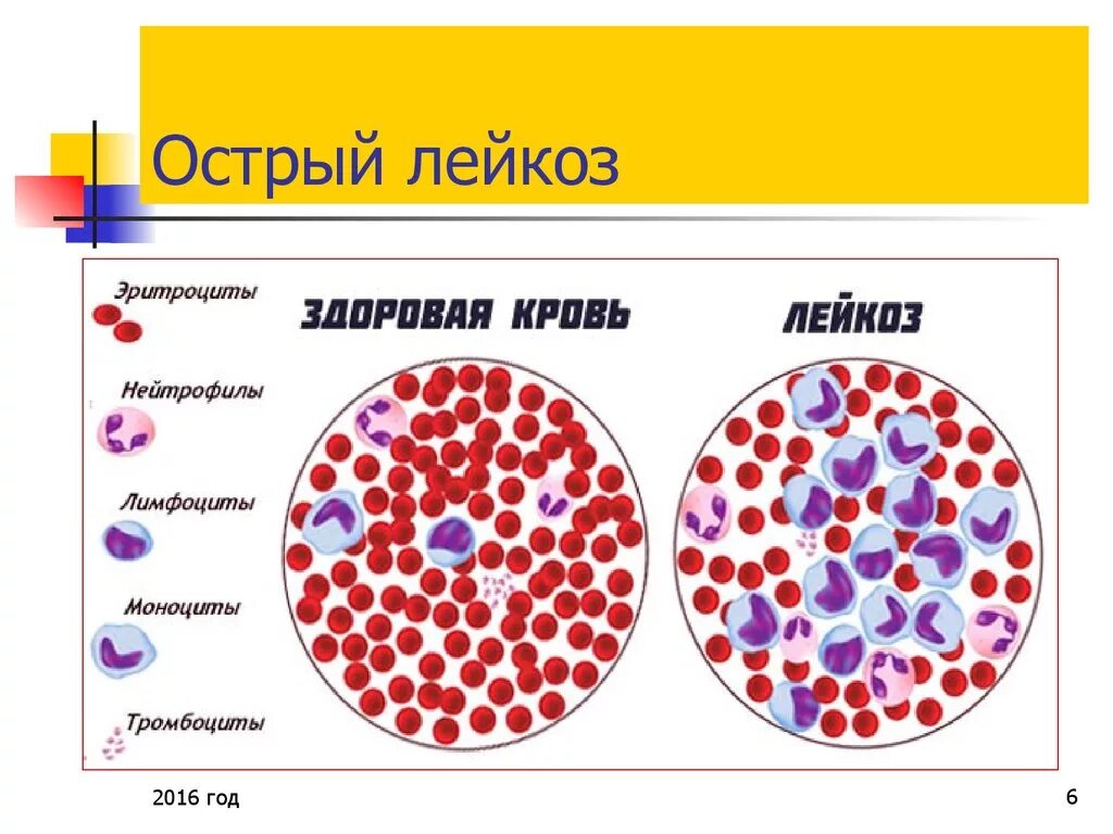 Острый лейкоз крови