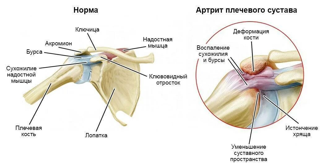 Как лечить сустав плеча. Лопаточно-плечевой артрит. ревматоидный артрит плеча. строение плечевого сустава человека и болезни. артропатия плечевого сустава лекарства.