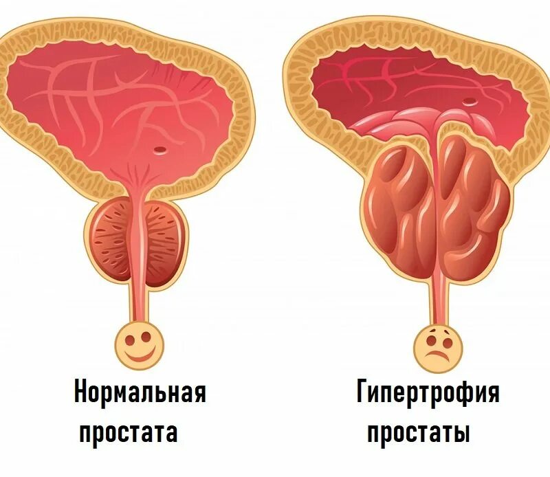 Простата это железа. Гипертрофия предстательной железы. Гипертрофия предстатель.