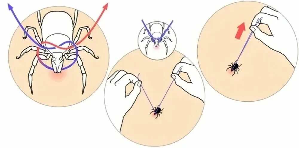 Удалить клеща в домашних условиях у человека. Выкручивание клеща ниткой. Извлечение клеща с помощью нитки. Как достать клеща с помощью нитки. Как удалить клеща ниткой.