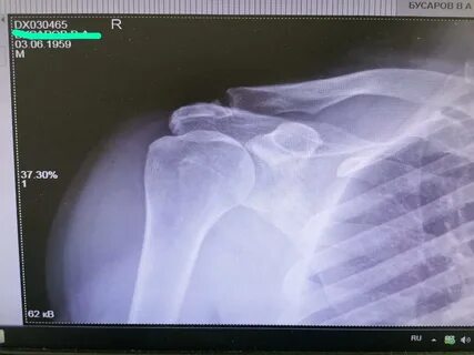 Акромиально ключичное сочленение плечевого сустава 2 степени