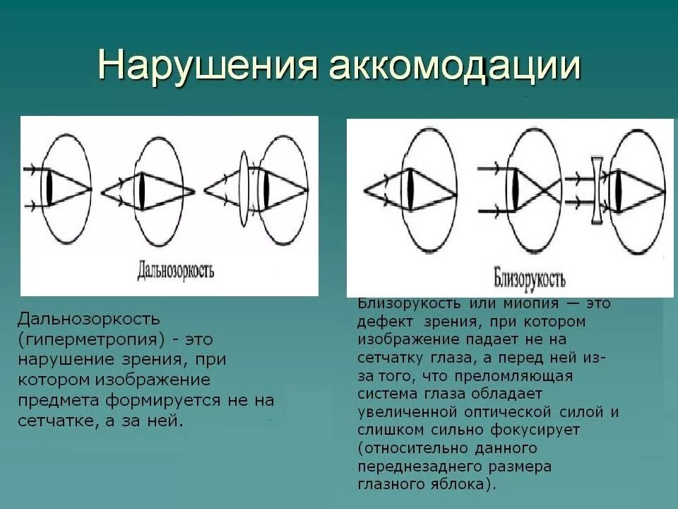 Заболевания аккомодации. Нарушение аккомодации. Аккомодация зрения. Нарушение аккомодации зрения. Нарушение аккулюдации.