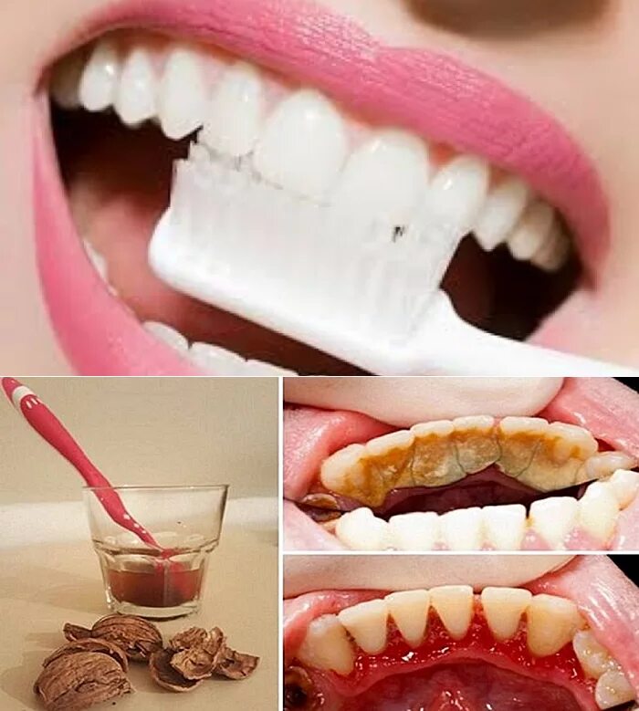 Как удалить зубную в домашних условиях. Зубной какамекакамень.