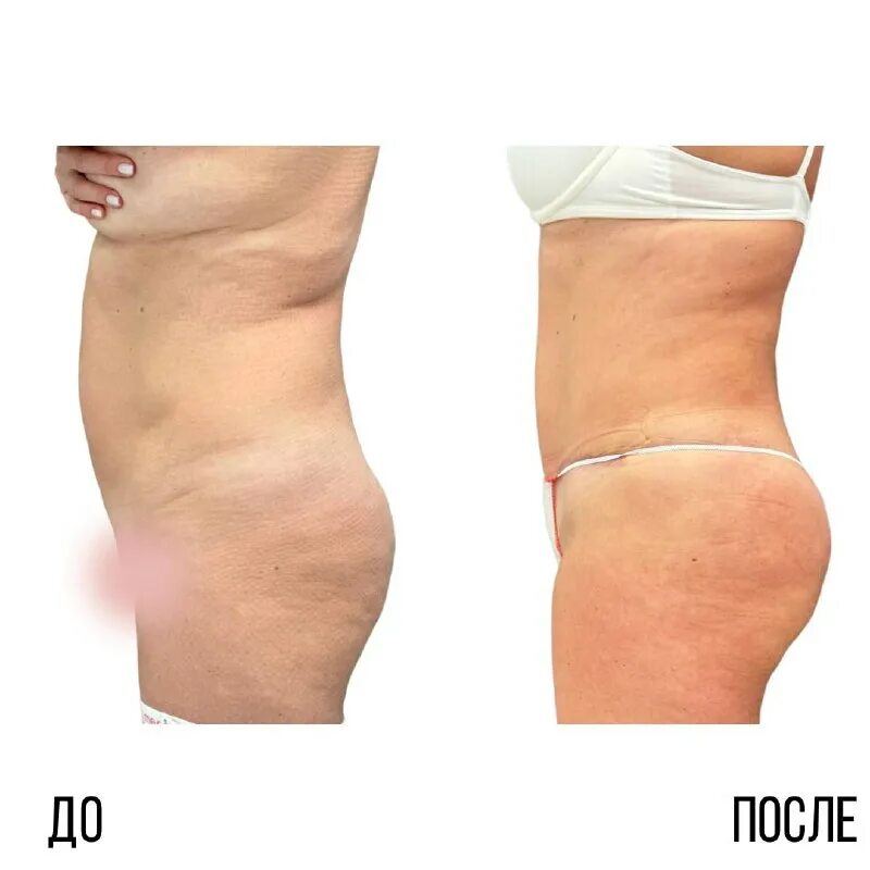 Глютеопластика липофилинг. Липофилинг ягодиц свиридов. Липофилинг внутренней части бедра. Липофилинг ягодиц. Липофилинг ягодиц.