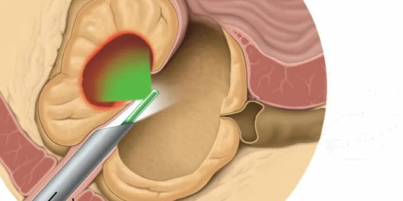 Лазерная вапоризация простаты. Вапоризация аденомы простаты. Трансуретральная вапоризация. Лазерная вапоризация предстательной железы. Трансуретральная резекция простаты.
