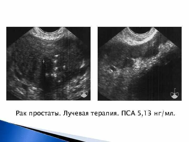 Дгпж узи. Трансабдоминальное УЗИ простаты. УЗИ трузи предстательной железы. Трансректальное УЗИ простаты. Опухоль предстательной железы УЗИ.