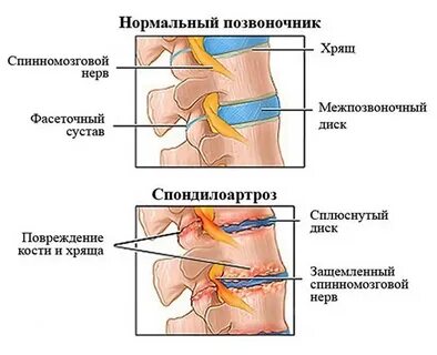 Деформация дисков позвоночника