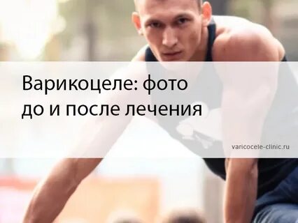 Что такое варикоцеле у мужчин