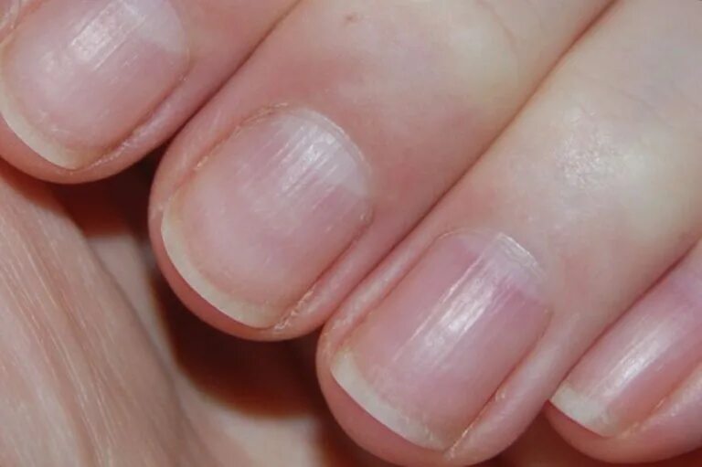 Почему ногти становятся жесткими. Продольные полосы на ногтях. Полоска на ногте вертикальная. Поперечные борозды на ногтях.