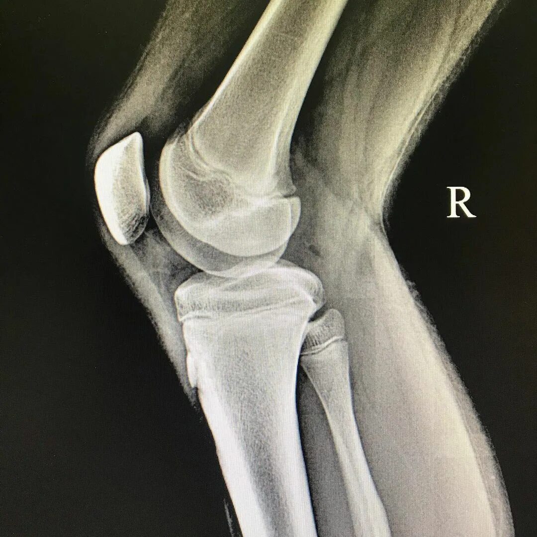 перелом бугристости большеберцовой кости. перелом бугристости большеберцовой кости с отрывом. перелом бугристости большеберцовой кости. перелом бугристости большеберцовой кости. болезнь осгуда шлаттера.