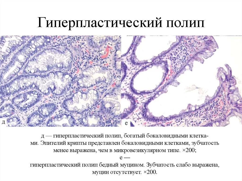 Микровезикулярный полип толстой кишки. Полип толстой кишки микропрепарат. Полип толстой кишки гистология. Гиперпластический полип толстой кишки гистология. Гиперпластический полип кишки гистология.