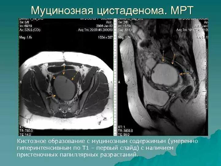 Киста яичника на мрт. Муцинозная опухоль яичника мрт. Муцинозная киста яичника мрт. Муцинозная цистаденома яичника мрт. Объемное образование яичника мрт.