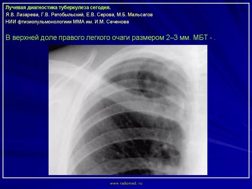 Очаг в верхней доле правого легкого. Очаги в доли правого лёгкого. Очаг в верхней доле легкого.