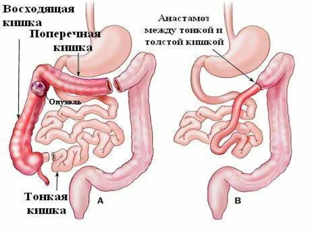 Искусственную прямую кишку