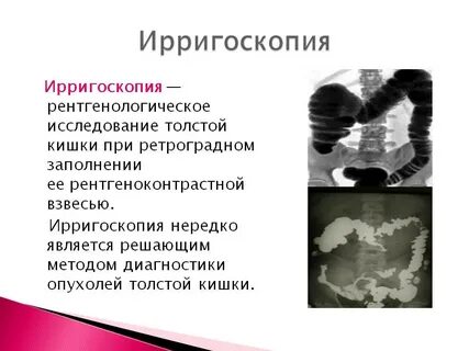 Ирригоскопия кишечника подготовка к исследованию