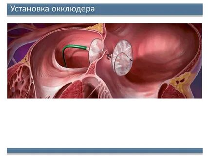 Закрытие дмпп окклюдером